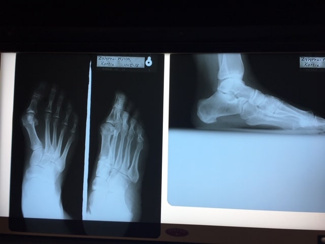Before Photo of Crooked Foot