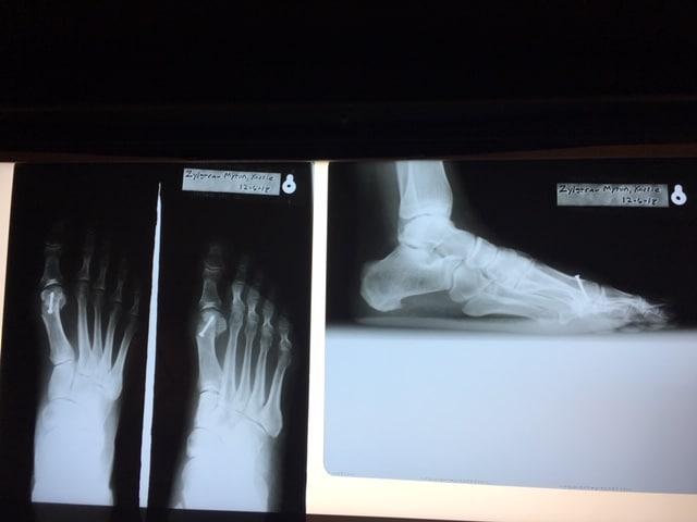 After Photo of Foot