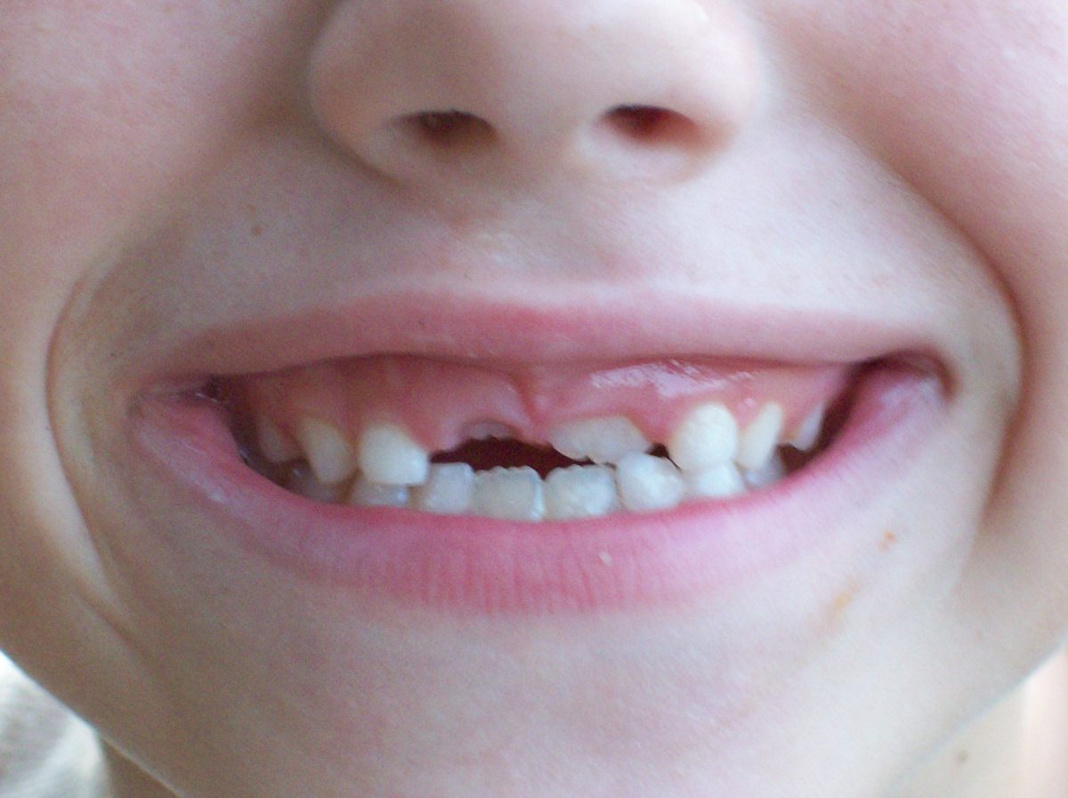 gap tooth